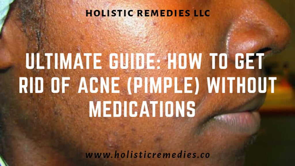 Ultimate Guide: How to get rid of Acne (Pimple) Without Medications