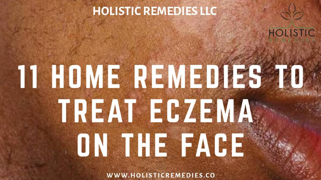11 Home Remedies to Treat Eczema on the Face