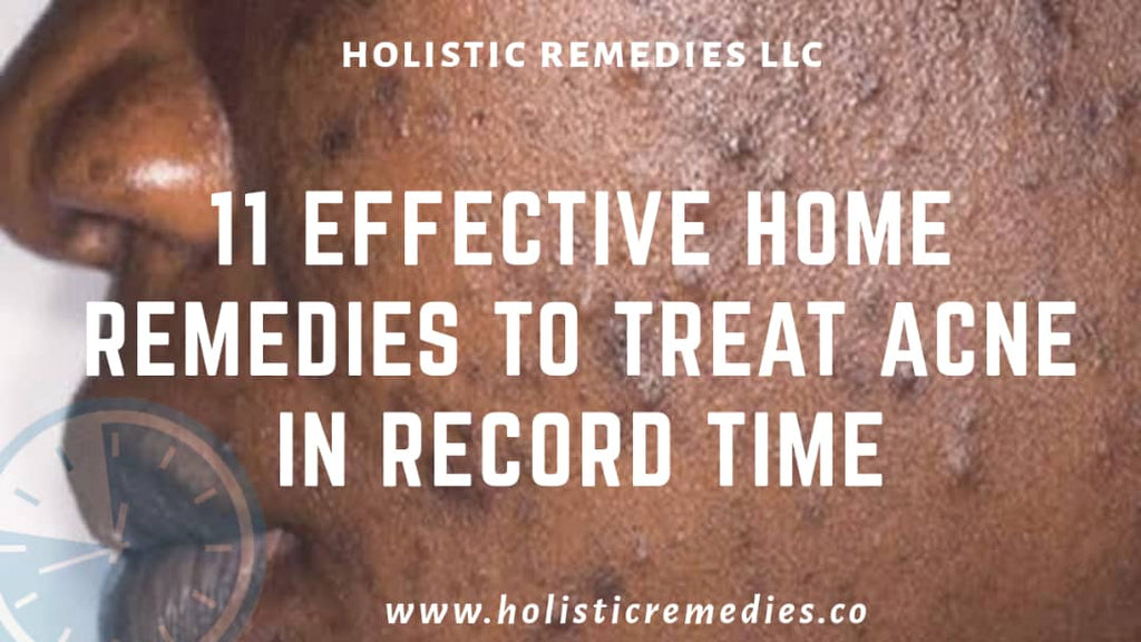 11 Effective Home Remedies to Treat Acne in Record Time